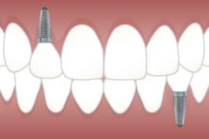 שיניים קידמיות